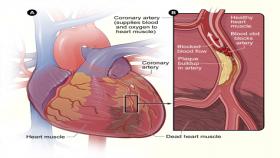 Atherosclerosis is the foremost cause of coronary artery disease, the number one killer of people in the United States. Credit: National Institutes of Health