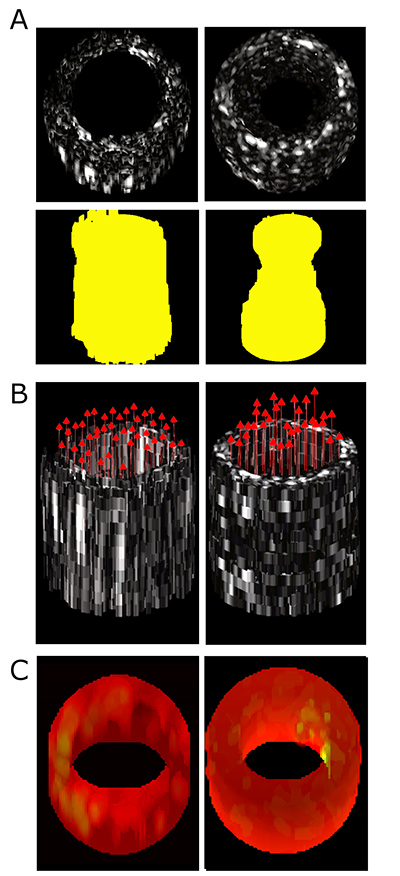 This figure shows 3D functional imaging with a prototype forward-viewing device in laboratory models of narrowed vessels: (A) Conventional ultrasound imaging of lesion morphology in straight and stenotic, or narrowed, vessels, with extracted lumen shape shown in yellow, (B) 3D vector velocity imaging in straight and stenotic vessels, and (C) Strain rate imaging of a control vessel model and a model with a soft inclusion on the right inner surface.