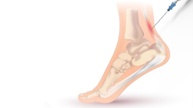 Illustration shows how the Ocelot device can be used to target the Achilles tendon in the heel to promote healing. (Image Courtesy: TendoNova)