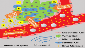 An illustration of improved delivery of anti-cancer drugs to malignancies in the brain. On the left half, focused ultrasound agitates microbubbles, which breach the blood-brain barrier, allowing drug molecules to get through. The forces also stir interstitial fluid to circulate the drug, and they also encourage the drug to cross cell membranes more easily into tumor cells. Credit: Massachusetts General Hospital / Georgia Tech / Arvanitis / Askoxylakis