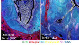 Multiplex bioimaging of human biopsy sample with 35 markers at a time. Distinct tissue architectures reveal the difference between health and disease in an immune tonsil organ. In this example, spatial distributions of different cell types and tissue structure were visualized by different colors: B-cells (CD20), Extracellular matrix (Collagen), T-cells (CD3), Cytotoxic protein (Granzyme-B), Cell proliferation (Ki67).
