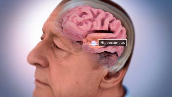 The brain of an Alzheimer's sufferer can dramatically lose mass and shrink. In particular, center structures of the brain usually diminish early on. One such region susceptible to early and severe damage is the hippocampus, which can lead to memory loss and disorientation. Illustration credit: National Institute on Aging, National Institutes of Health