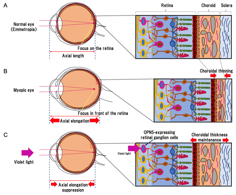 A diagram illustrating how violet light interacts with the photoreceptor protein OPN5 to prevent progression of myopia. At top, A, a normal eye. In the middle, B, shows a myopic eye with characteristic elongation between the cornea and the retina and a thinning of the vascular layer called the choroid. The bottom, C, shows that violet suppresses the elongation and thinning of the choroid. (Illustration: Toshihide Kurihara)