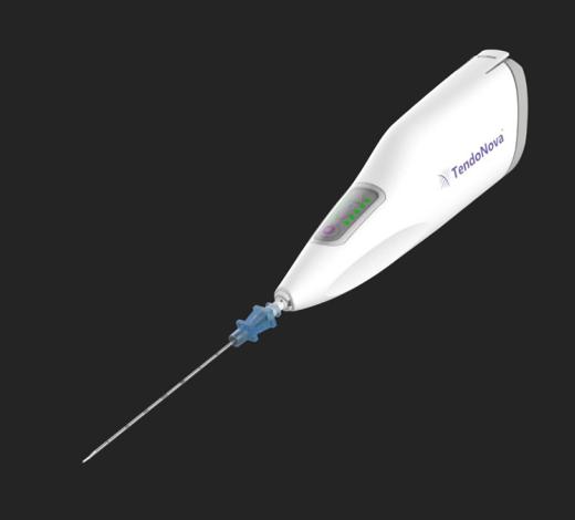 TendoNova's Ocelot device, a handheld tool to perform mechanical fragmentation and debridement of targeted tissues, a common procedure for athletes and others suffering from tendon pain disorders like tennis elbow, plantar fasciitis, and jumper’s knee. (Image Courtesy: TendoNova)